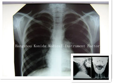 Dijital Tıbbi Röntgen Kuru Film 14x17 inç Sağlık Görüntüleme Radyografik Film