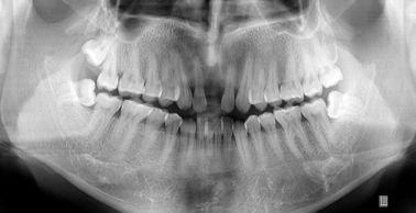İyi bir fiyat. Termal Yazıcı İçin Özel Suya Dayanıklı Tıbbi Teşhis Görüntüleme X Ray Filmi çevrimiçi