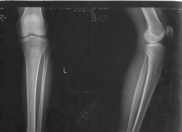 İyi bir fiyat. 32 cm * 43 cm Xray Kağıt Tıbbi Lazer Görüntüleme Filmi KND-DRYTEC-4000 KND-K çevrimiçi