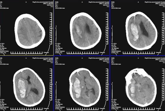 İyi bir fiyat. Konida Lazer Yazıcı için su geçirmez Tıbbi Röntgen Teşhis Görüntüleme KND-K çevrimiçi