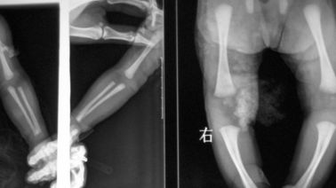Good price 20 x 25cm Lazer X Ray Tıbbi Görüntüleme, DT1B / DT2B Agfa X Ray Filmi çevrimiçi