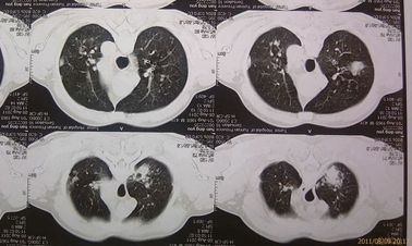 Agfa Termal Yazıcı için Çift Katmanlı DT2B Tıbbi Kuru Film X Ray