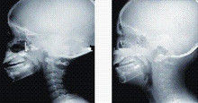 Yüksek Mürekkep Kapsamlı X Ray Teşhis Görüntüleme, 35 x 43cm Lazer Tıbbi röntgen Filmi