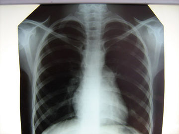 Termal Yazıcılı Hastane Berrak Tıbbi X-Ray Film Konida