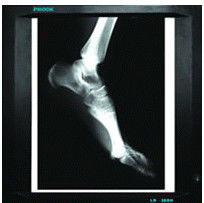 20cm x 25cm Tıbbi Teşhis Görüntüleme, Lazer Yazıcı Filmi X Ray Kağıdı