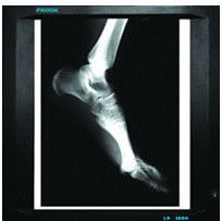Good price 20cm x 25cm Tıbbi Teşhis Görüntüleme, Lazer Yazıcı Filmi X Ray Kağıdı çevrimiçi