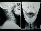 X Ray Tıbbi Görüntüleme Filmi