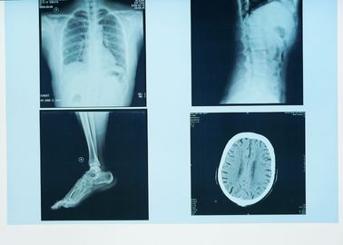 Dayanıklı X Ray Teşhis Görüntüleme, 32 cm x 43 cm Tıbbi Kağıt Lazer Mavi X Ray Filmi