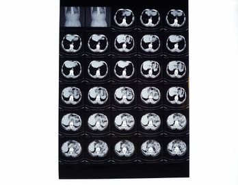 Tıbbi X ışını Filmleri, CT / DR / MRI için Termal Yazıcı ile Uyumlu Kuru Görüntüleme Filmi