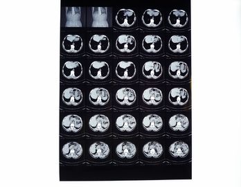 Good price Tıbbi X ışını Filmleri, CT / DR / MRI için Termal Yazıcı ile Uyumlu Kuru Görüntüleme Filmi çevrimiçi