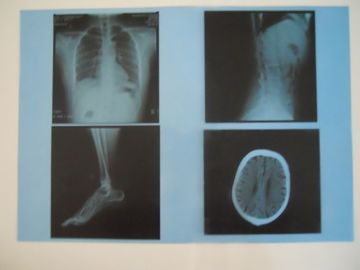 Good price AGFA 5300/5302/5500 Üzerinde X Ray Muayenesi için KND-A Düşük Sisli Tıbbi Kuru Görüntüleme Filmi çevrimiçi