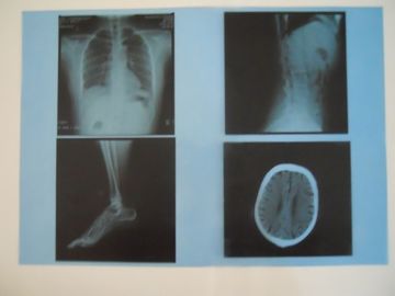 AGFA 5300/5302/5500 Üzerinde X Ray Muayenesi için KND-A Düşük Sisli Tıbbi Kuru Görüntüleme Filmi