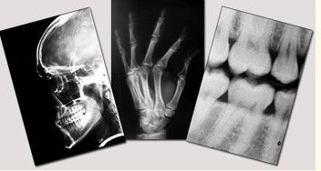 Good price Mavi Tıbbi Kuru Görüntüleme Filmi, 11in x 14in Lazer Fuji X Ray Filmi çevrimiçi